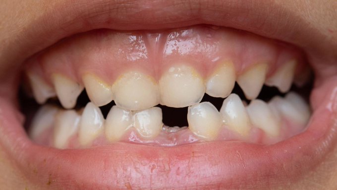 Medicamento para hacer crecer los dientes empezará a ensayarse en humanos este año