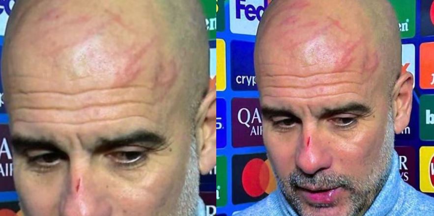 Guardiola apareció con heridas en su rostro tras el empate entre Manchester City y Feyenoord