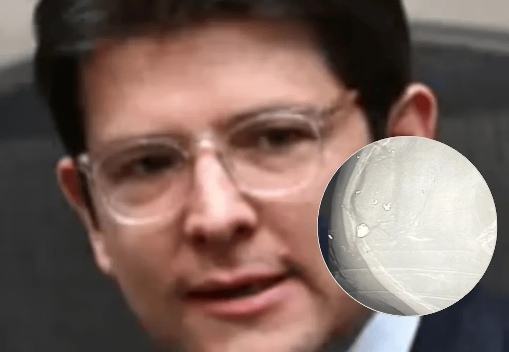 Impactante radiografía revela cómo quedó el cráneo de Miguel Uribe tras el atentado