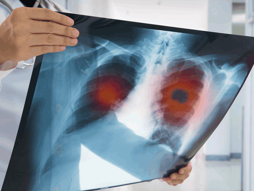 Estos son los alimentos que producen cáncer en el pulmón