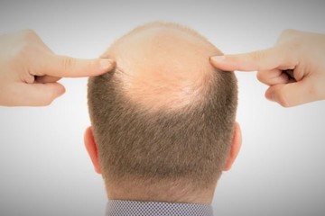 Día Mundial de los Calvos: ¿Por qué se celebra?