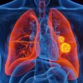 Eliminan del ADN las mutaciones más frecuentes de un gen vinculado al cáncer de pulmón