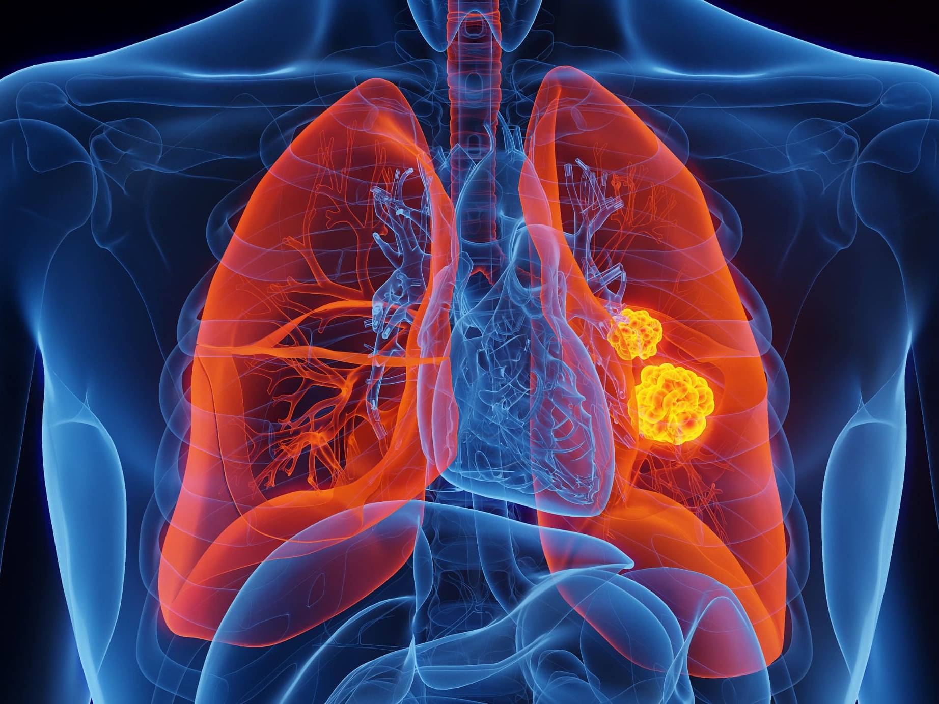 Eliminan del ADN las mutaciones más frecuentes de un gen vinculado al cáncer de pulmón